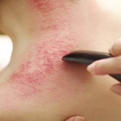 Gua sha in traditional Chinese medicine