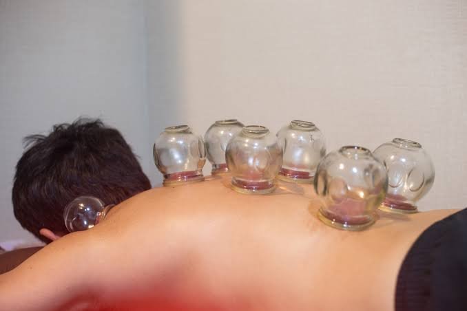 Cupping in traditional Chinese medicine