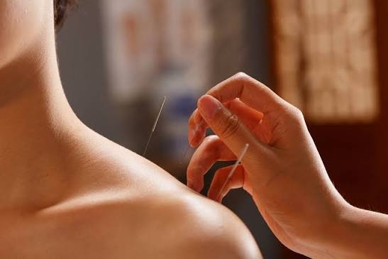 Acupuncture in traditional Chinese medicine